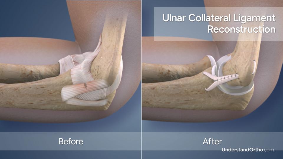 tommy john surgery before after